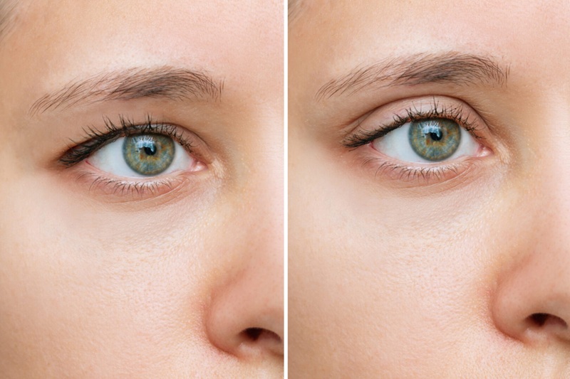 Blepharoplasty Facial Surgery Clinic Belfast