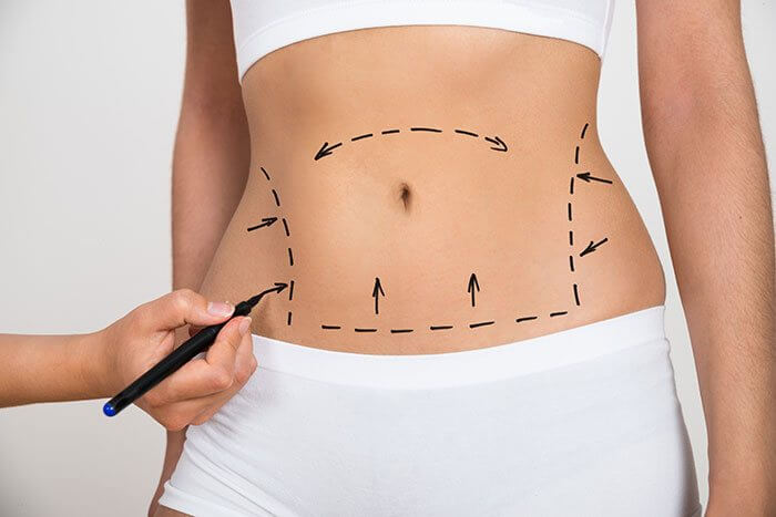 Advanced Liposuction Surgery Belfast Ireland