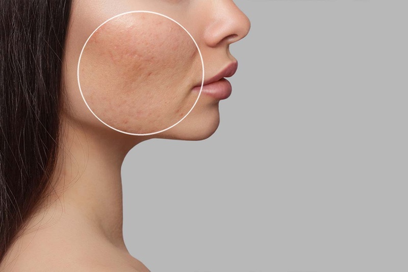 Scar Treatment Surgery Belfast